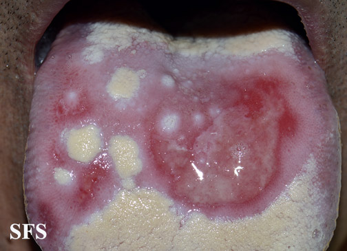 Behçet'S Syndrome (Dermatology Atlas 18).jpg