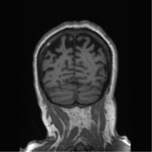 Behavioral variant frontotemporal dementia and late onset schizophrenia (Radiopaedia 52197-58083 Coronal T1 25).png