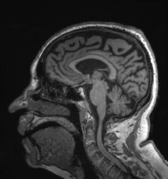 Behavioral variant frontotemporal dementia and late onset schizophrenia (Radiopaedia 52197-58083 Sagittal T1 53).png
