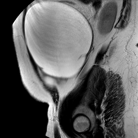 File:Benign seromucinous cystadenoma of the ovary (Radiopaedia 71065-81300 Sagittal T2 21).jpg