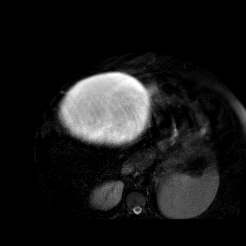 File:Benign seromucinous cystadenoma of the ovary (Radiopaedia 71065-81300 T2 SPAIR 34).jpg