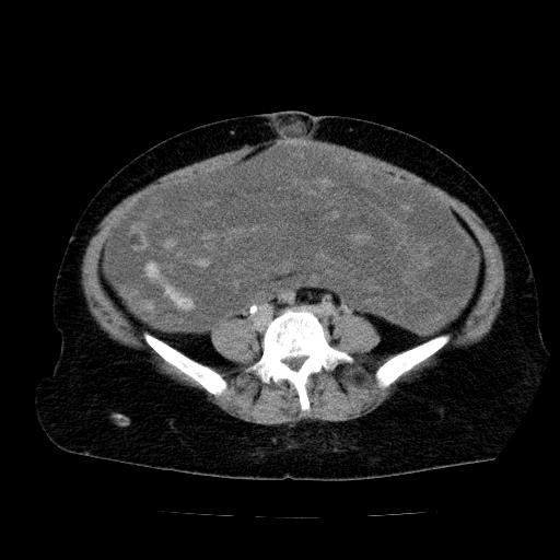 Benign spindle cell tumor - abdominopelvic (Radiopaedia 61300-69212 Axial C+ delayed 41).jpg