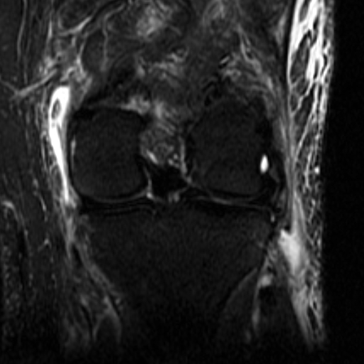 File:Biceps femoris distal tendon avulsion (Radiopaedia 15109-14987 Coronal STIR 5).jpg