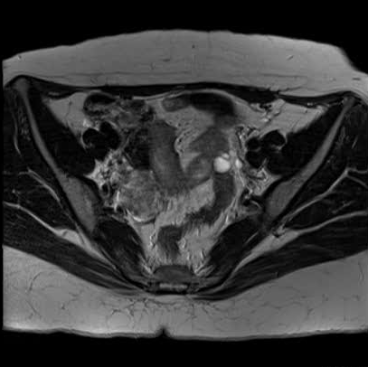 File:Bicornuate uterus (MRI) (Radiopaedia 49206-54297 Axial 27).png