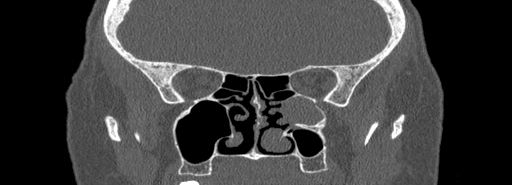 Bilateral Ectopic Infraorbital Nerves (Radiopaedia 49006-54084 Coronal bone window 49).jpg