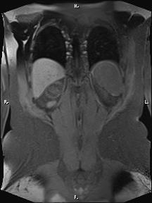 Bilateral adrenal myelolipoma (Radiopaedia 63058-71537 Coronal T1 fat sat 19).jpg