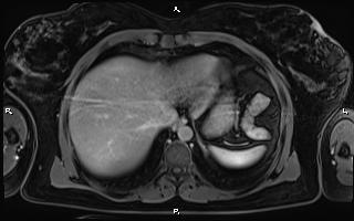 File:Bilateral adrenal myelolipoma (Radiopaedia 63058-71537 H 15).jpg
