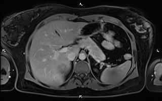 File:Bilateral adrenal myelolipoma (Radiopaedia 63058-71537 H 29).jpg