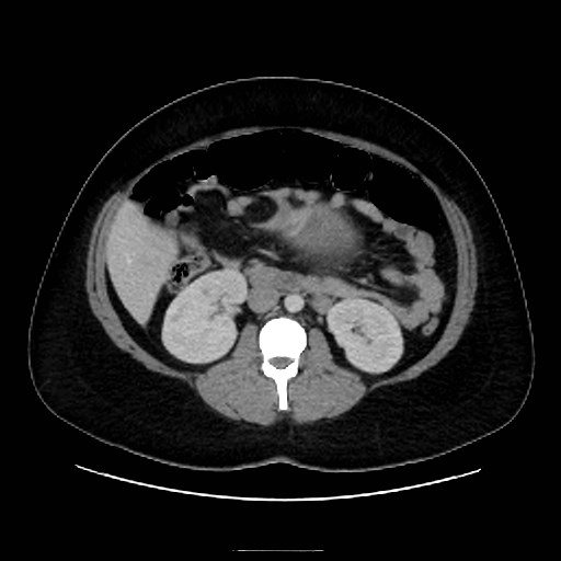 Bilateral adrenal thrombosis (Radiopaedia 58182-65256 A 33).jpg