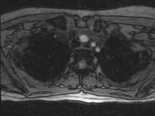 Bilateral carotid body tumors and right glomus jugulare tumor (Radiopaedia 20024-20060 Axial MRA 167).jpg