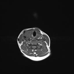 File:Bilateral carotid body tumors and right jugular paraganglioma (Radiopaedia 20024-20060 Axial 6).jpg