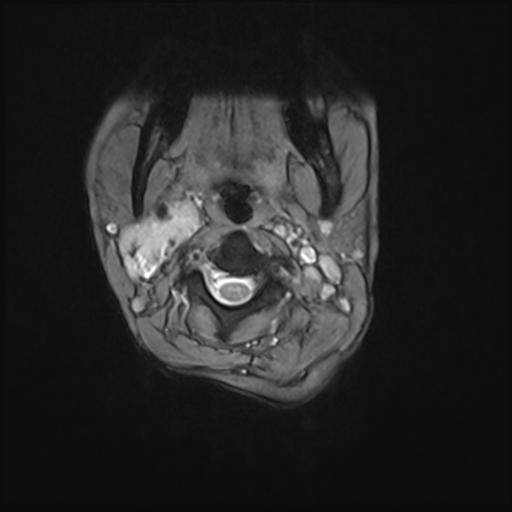 File:Bilateral carotid body tumors and right jugular paraganglioma (Radiopaedia 20024-20060 Axial 70).jpg