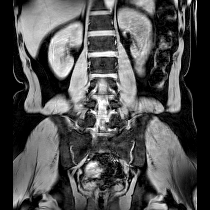 Bilateral conjoined nerve roots at different levels (Radiopaedia 73312-84063 Coronal WE 29).jpg