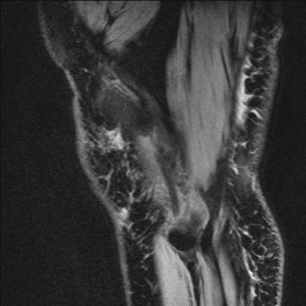 Bilateral focal pigmented villonodular synovitis (Radiopaedia 67643-77046 G 59).jpg