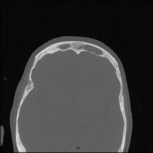 File:Bilateral frontal mucoceles (Radiopaedia 82352-96454 Axial bone window 88).jpg