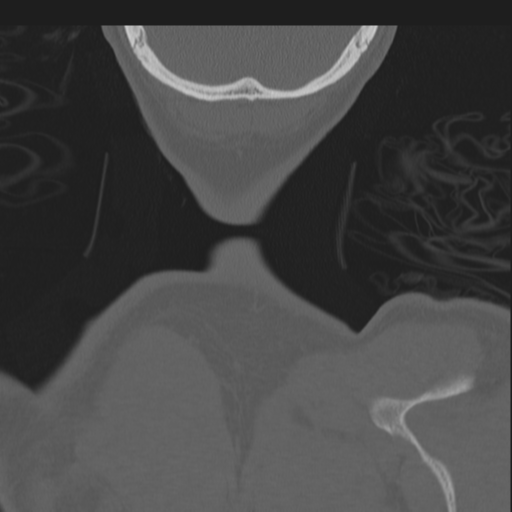 Bilateral locked facets (Radiopaedia 33850-35016 Coronal bone window 94).png