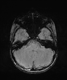 File:Bilateral mesial temporal polymicrogyria (Radiopaedia 76456-88181 Axial SWI 13).jpg