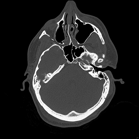 Bilateral occipital condyle fracture (type 2) (Radiopaedia 87675-104089 Axial bone thins 72).jpg