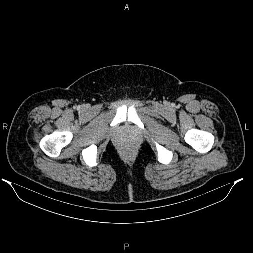 Bilateral ovarian dermoid cysts (Radiopaedia 85785-101603 A 112).jpg