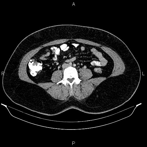 Bilateral ovarian dermoid cysts (Radiopaedia 85785-101603 A 64).jpg