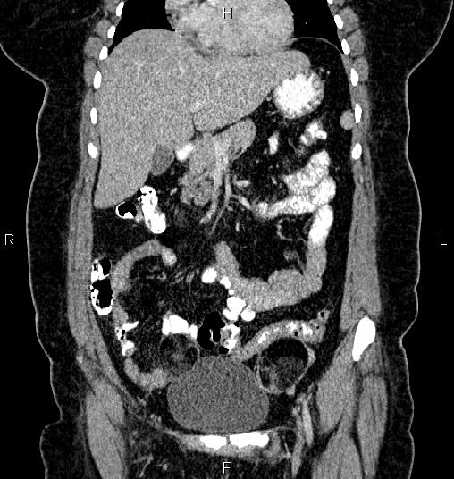 File:Bilateral ovarian dermoid cysts (Radiopaedia 85785-101603 C 16).jpg