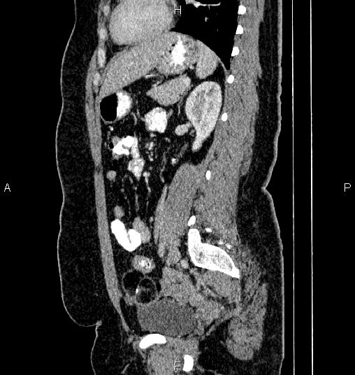 Bilateral ovarian dermoid cysts (Radiopaedia 85785-101603 D 60).jpg