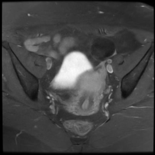 File:Bilateral ovarian dermoid cysts (Radiopaedia 90152-107338 Axial T1 C+ fat sat 11).jpg