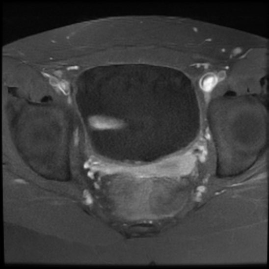 File:Bilateral ovarian fibrothecomas - adolescent (Radiopaedia 86604-102707 Axial T1 C+ fat sat 20).jpg