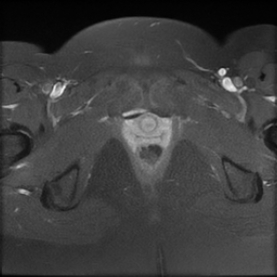 File:Bilateral ovarian fibrothecomas - adolescent (Radiopaedia 86604-102707 Axial T1 C+ fat sat 28).jpg