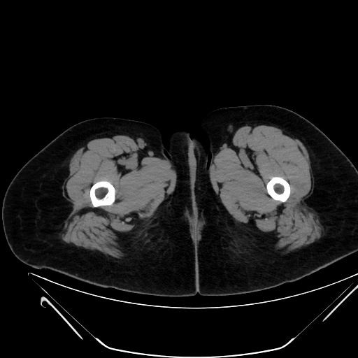 File:Bilateral ovarian mature cystic teratomas (Radiopaedia 79373-92457 Axial non-contrast 114).jpg
