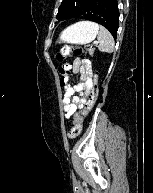 Bilateral ovarian serous cystadenocarcinoma (Radiopaedia 86062-101989 E 72).jpg