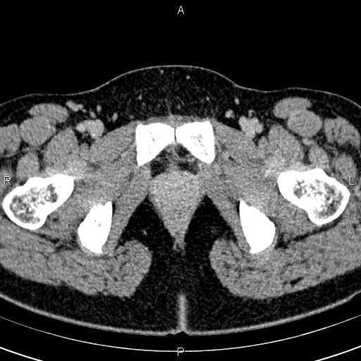 Bilateral ovarian teratoma (Radiopaedia 83131-97503 B 80).jpg