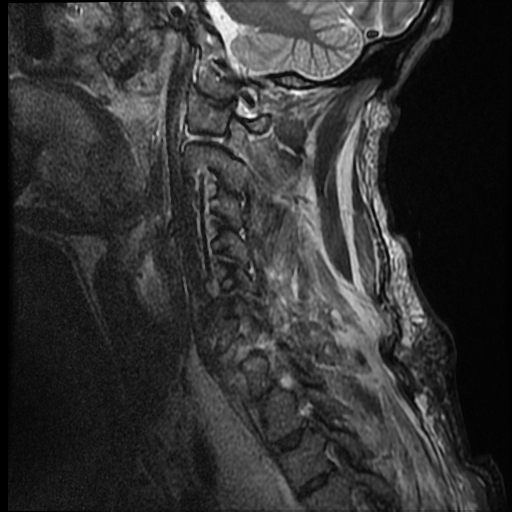 File:Bilateral perched facets with cord injury (Radiopaedia 45587-49714 Sagittal STIR 3).jpg