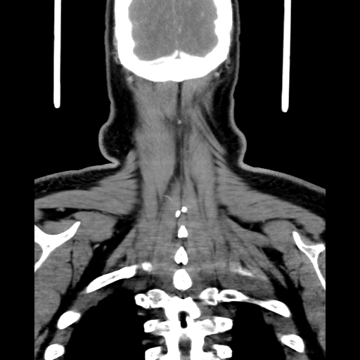 File:Bilateral peritonsillar abscess (Radiopaedia 85065-100610 Coronal 66).jpg