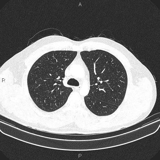 File:Bilateral pulmonary AVM (Radiopaedia 83134-97505 Axial lung window 25).jpg