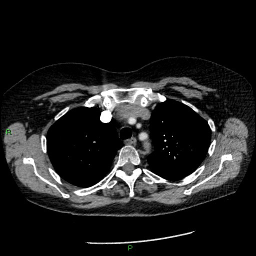 Bilateral pulmonary emboli (Radiopaedia 32700-33669 Axial C+ CTPA 27).jpg