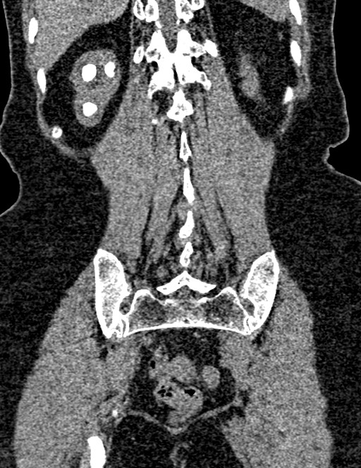 Bilateral staghorn calculi (Radiopaedia 59475-66842 Coronal non-contrast 81).jpg