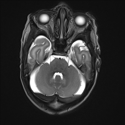 File:Bilateral subdural hemorrhage and parietal skull fracture (Radiopaedia 26058-26190 Axial T2 11).png