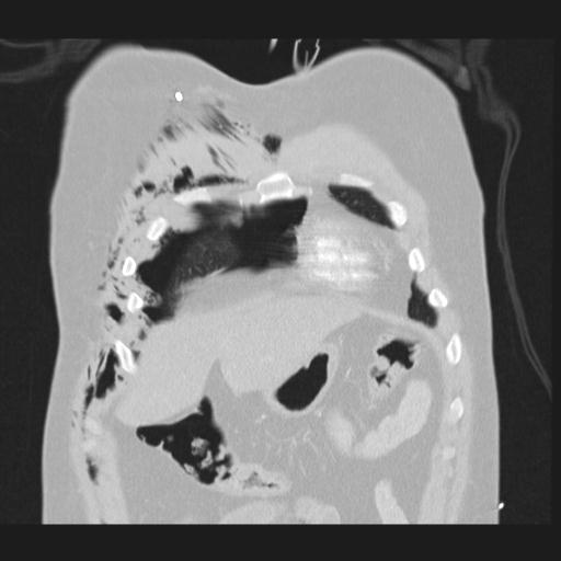 Bilateral traumatic renovascular injury (Radiopaedia 32051-32995 Coronal lung window 15).jpg