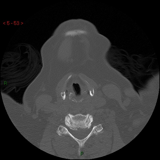 Bisphosphonate-related osteonecrosis of the jaw (Radiopaedia 54147-60329 Axial bone window 47).jpg