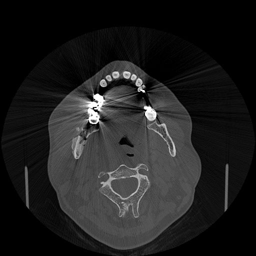 File:Bisphosphonate-related osteonecrosis of the jaw (Radiopaedia 71324-81642 Axial bone window 80).jpg