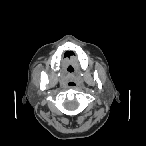 File:Bisphosphonate-related osteonecrosis of the jaw (Radiopaedia 71324-81642 non-contrast 106).jpg