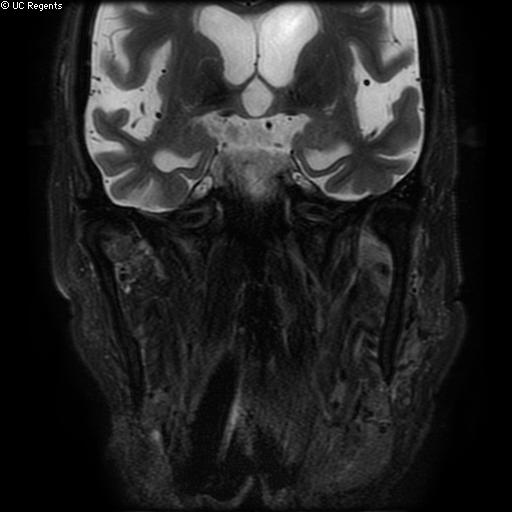 File:Bisphosphonate-related osteonecrosis of the maxilla (Radiopaedia 51367-57101 Coronal T2 fat sat 6).jpg