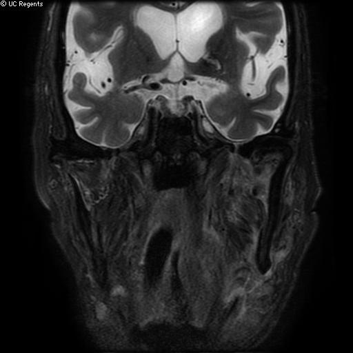 File:Bisphosphonate-related osteonecrosis of the maxilla (Radiopaedia 51367-57101 Coronal T2 fat sat 8).jpg