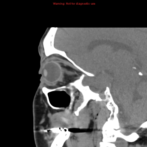 File:Blowout fracture with inferior rectus entrapment (Radiopaedia 12418-12673 C 9).jpg