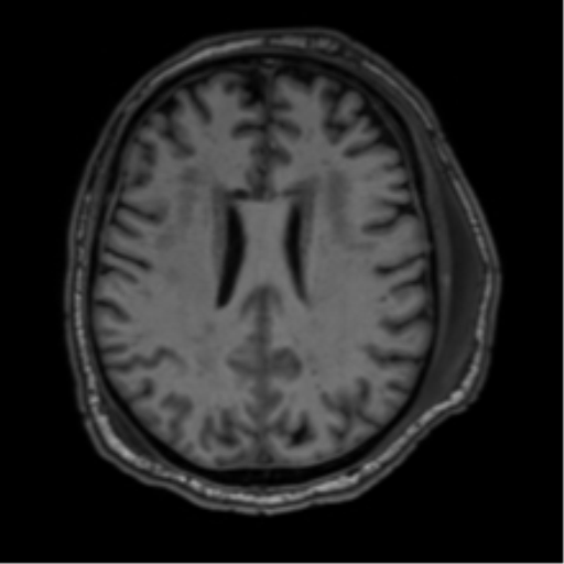 File:Blunt cerebrovascular injury (Radiopaedia 53682-59745 Axial T1 21).png