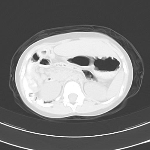 File:Bochdalek diaphragmatic hernia (Radiopaedia 38866-41059 Axial lung window 27).jpg