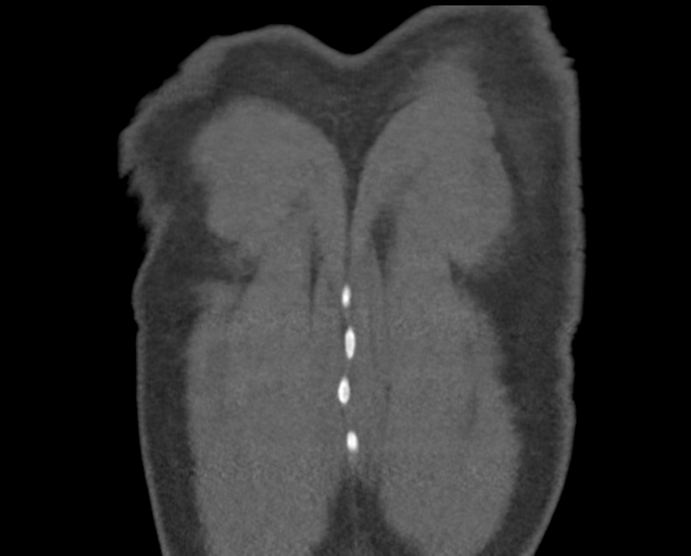 Boerhaave syndrome (Radiopaedia 39382-41660 C 87).png