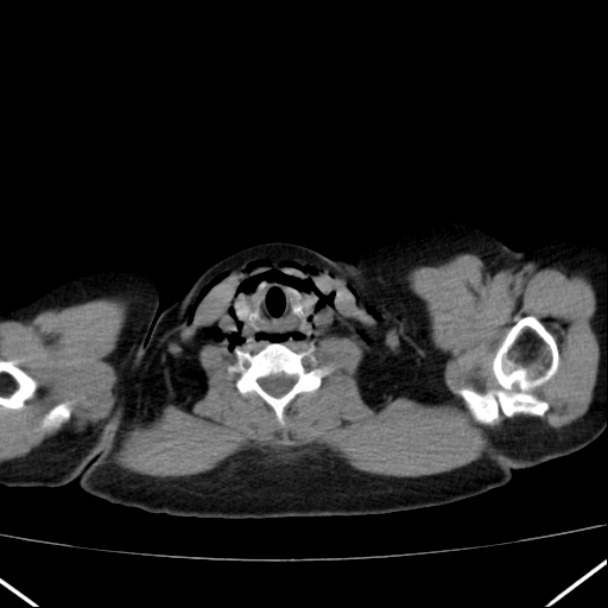 Boerhaave syndrome (Radiopaedia 45644-49799 Axial non-contrast 11).jpg