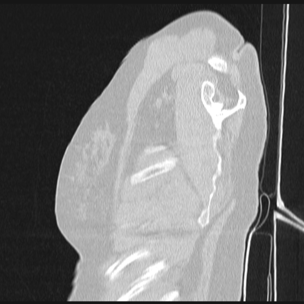 Boerhaave syndrome (Radiopaedia 45644-49799 Sagittal lung window 3).jpg